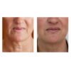 Profhilo Haenkenium® cream - Image 5