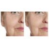 Profhilo Haenkenium® cream - Image 6