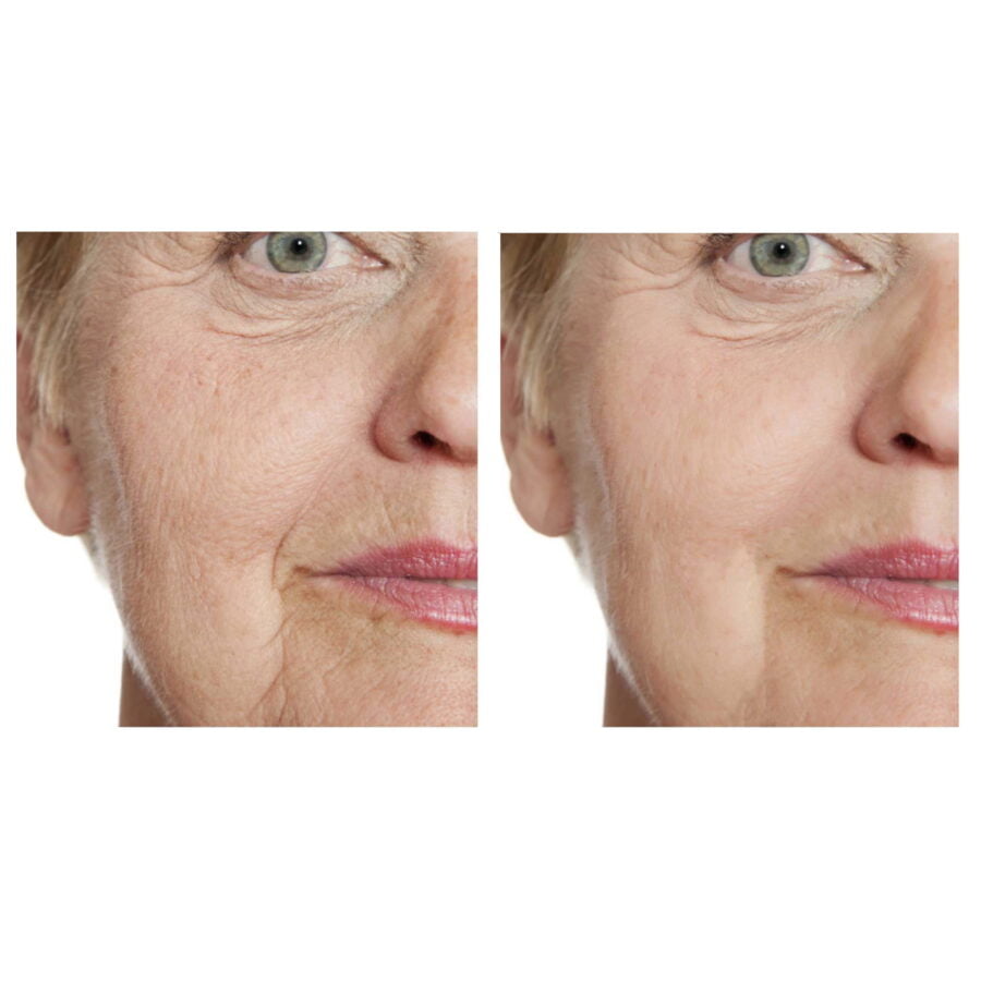 Profhilo Haenkenium® cream - Image 6