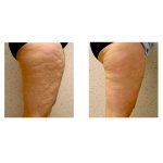 Fusion Mesotherapy F-XBC body home-care kit  - Image 2