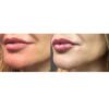 Fusion Mesotherapy Perfect Lips home care kit - Image 2