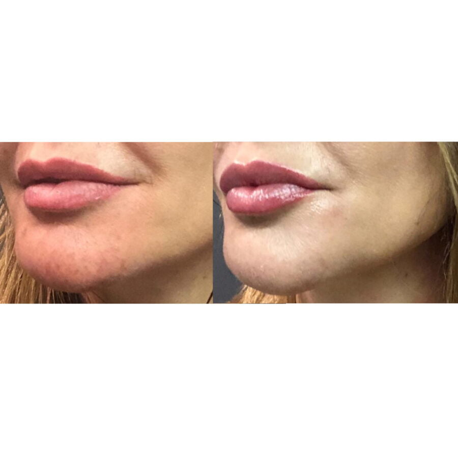 Fusion Mesotherapy Perfect Lips Ampoule - Image 2