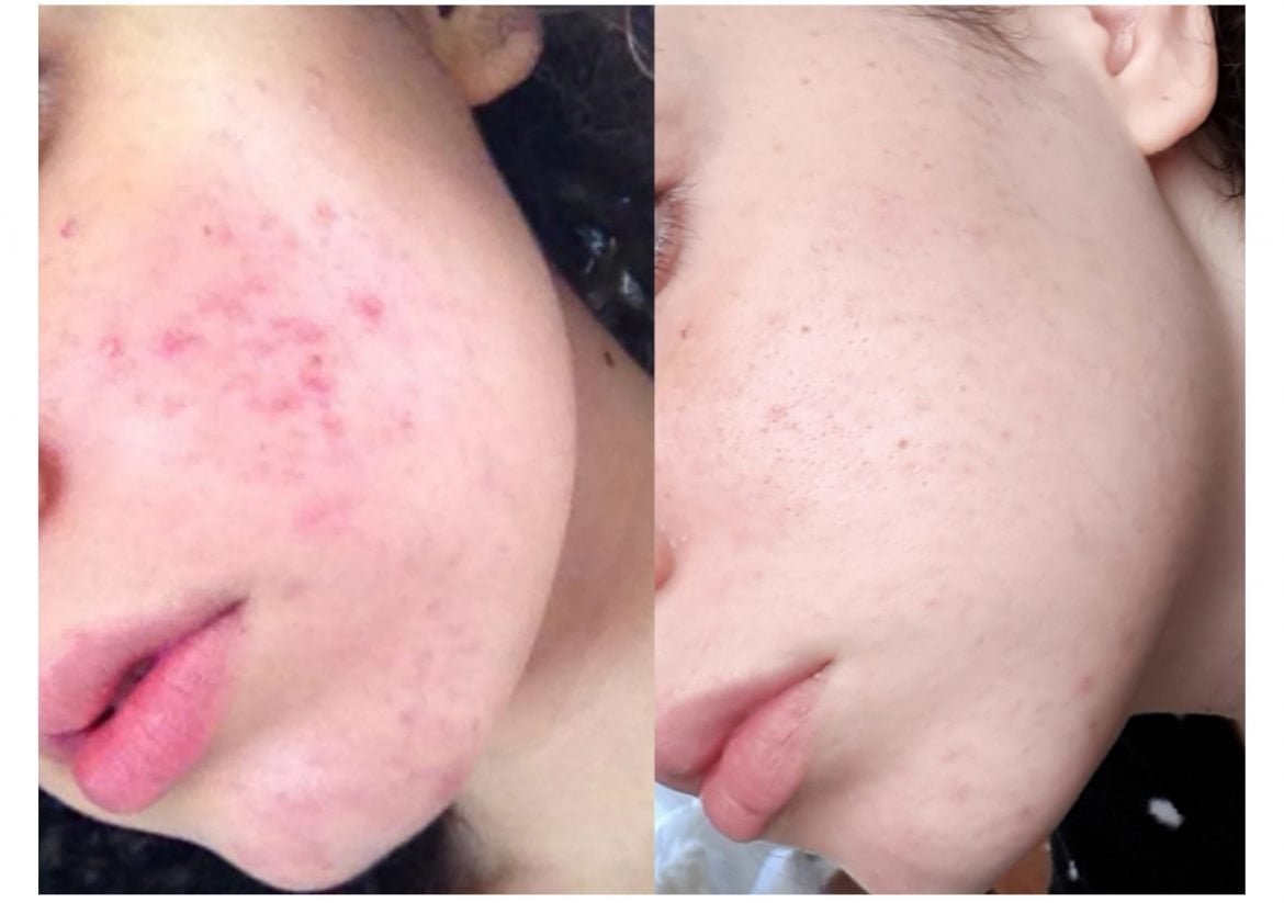 Eneomey-Masque-Peel