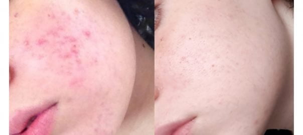 Eneomey-Masque-Peel
