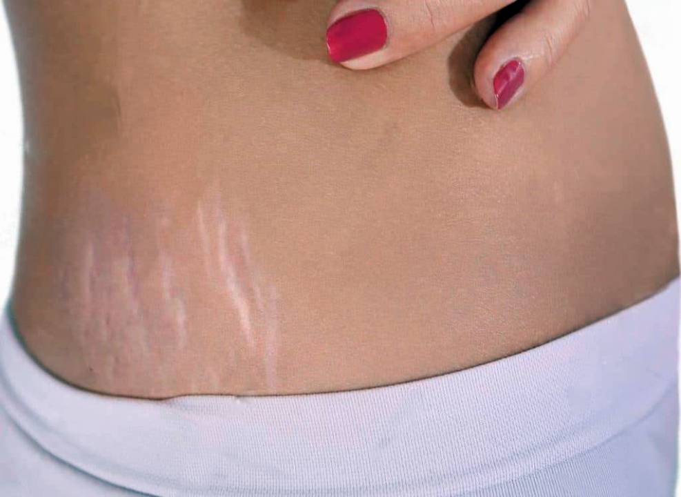 علامات التمدد